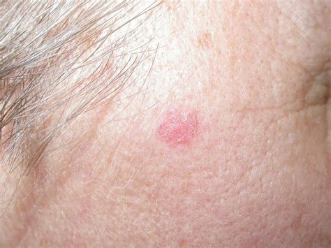 To learn more about how IG-SRT works,. . What happens if you pick at a basal cell carcinoma